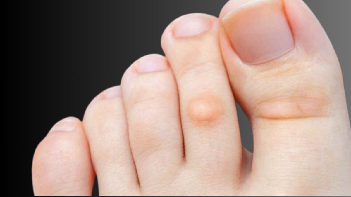 Blisterata: Understanding the Causes, Symptoms, and Treatment Options